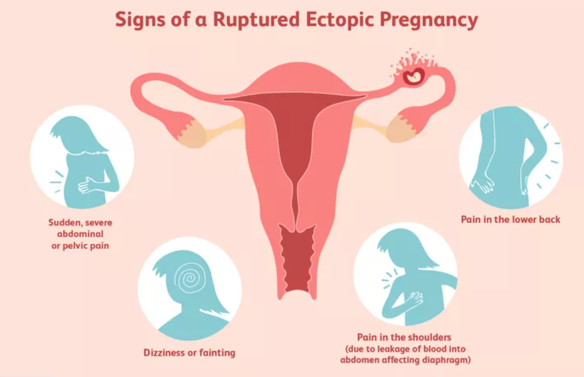 Ectopic pregnancies: clarifying contraception risk