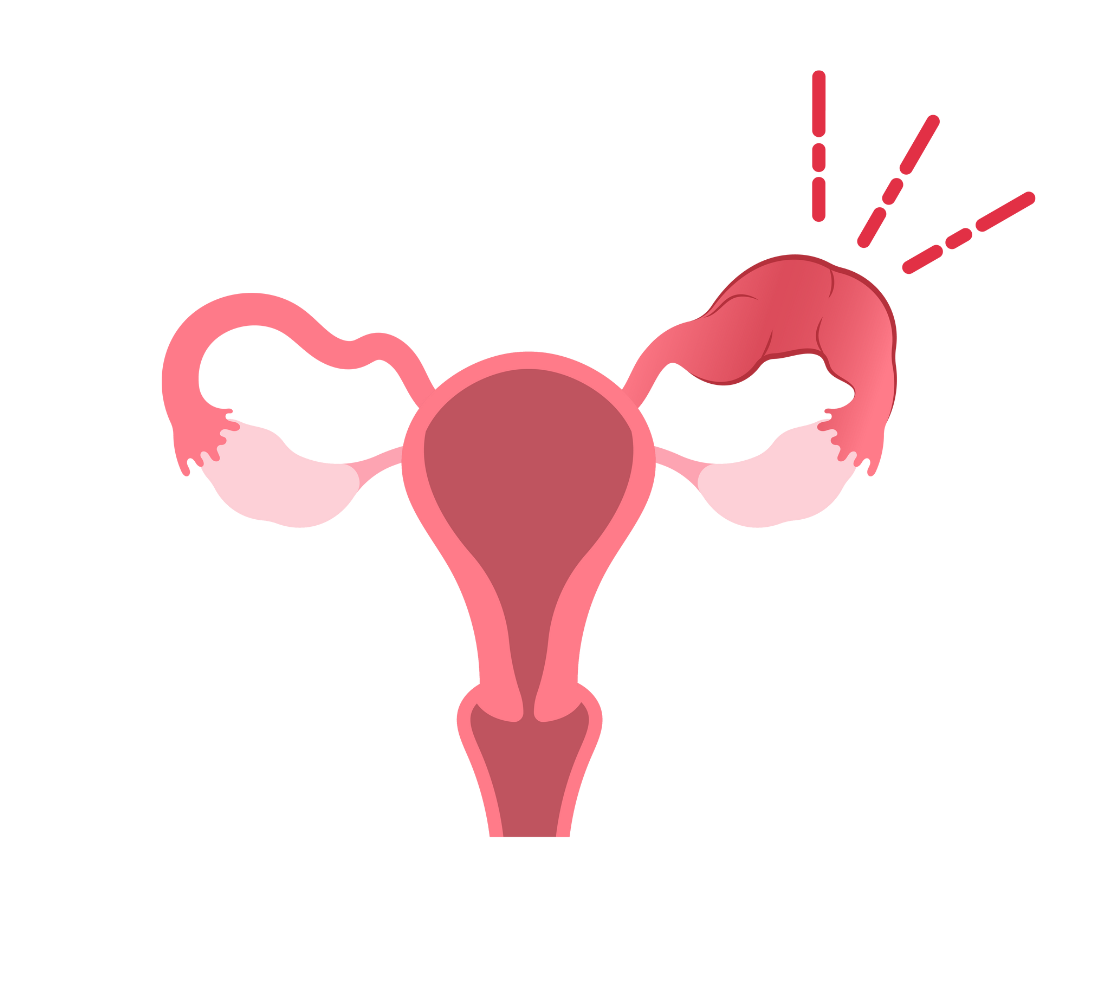 Ectopic pregnancies: clarifying contraception risk