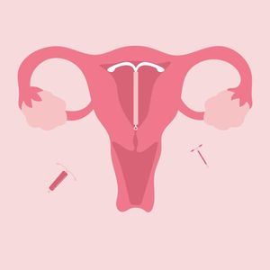 LARCs: what are long-acting reversible contraceptives?